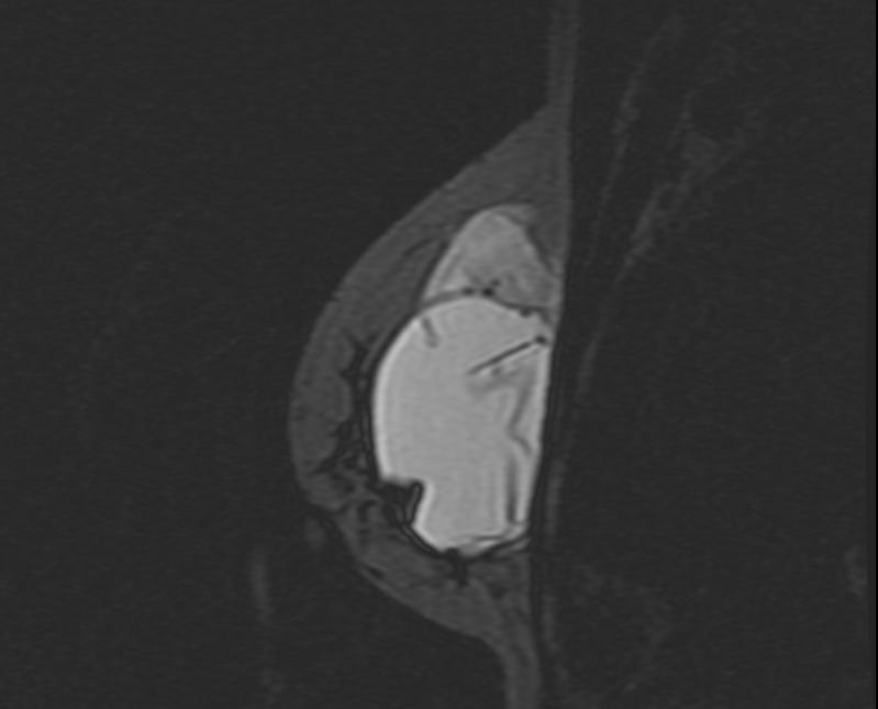 Breast MRI: Intra and extracapsular rupture
