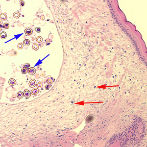 Cross-section of a proglottid of Taenia sp., stained with H&E. Note the thick outer tegument and the loose parenchyma filling the body. Calcareous corpuscles (red arrows), characteristic of the cestodes, can be seen in the parenchyma. Eggs (blue arrows) can also be seen. Image courtesy of the Washington State Public Health Laboratories. Adapted from CDC