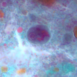 Cyst of E. polecki stained with trichrome. Notice the large nucleus with a pleomorphic karyosome and numerous variably-shaped chromatoid bodies. Adapted from CDC