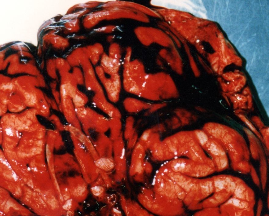 Subarachnoid hemorrhage gross pathology