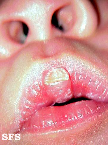 Lip callosity. Adapted from Dermatology Atlas.[1]