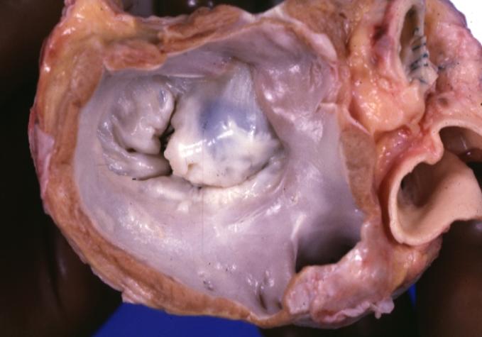 Cardiomyopathy: Gross view from the left atrium, in which the mitral valve anterior leaflet appears to balloon a bit into the atrium