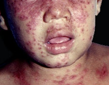 File:Atopic Dermatitis05.jpg