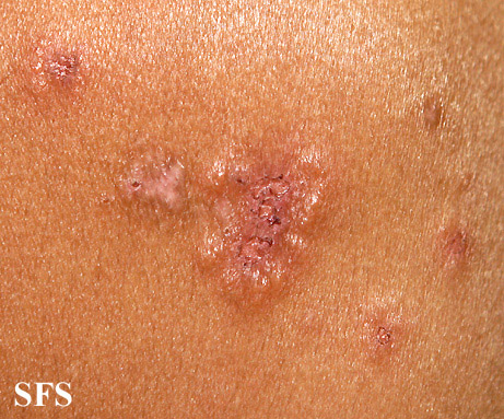 File:Dermatitis herpetiformis27.jpg