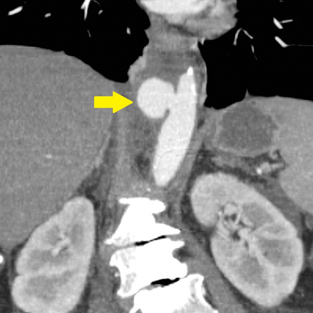 File:Penetrating-aortic-atherosclerotic-ulcer-with-false-aneurysm (2).jpg