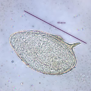 Egg of S. mansoni in an unstained wet mount. Images courtesy of the Wisconsin State Laboratory of Hygiene. Adapted from CDC