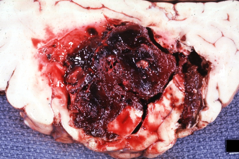 Brain: Hemorrhage Massive With Lupus Erythematosus: Gross natural color not the best exposure but OK large left frontoparietal hemorrhage in 16yo female with advanced lupus nephritis and sepsis