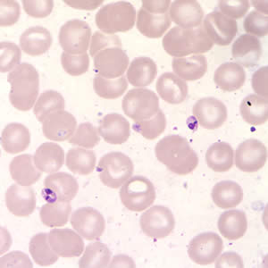 Leishmania (Viannia) panamensis amastigotes in a Giemsa-stained tissue scraping. Identification to the species level is not possible based on morphology and other diagnostic techniques such isoenzyme assay or PCR are needed. Adapted from CDC