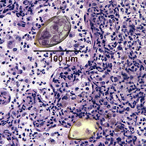 Eggs of Paragonimus sp. taken from a lung biopsy stained with hematoxylin and eosin (H&E). These eggs measured 80-90 µm by 40-45 µm. The species was not identified in this case. Adapted from CDC