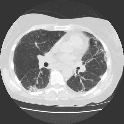 CT:Lung involvement in Scleroderma