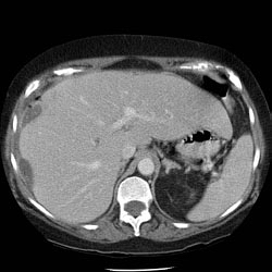 Perforated cholecystitis with subphrenic abscess.