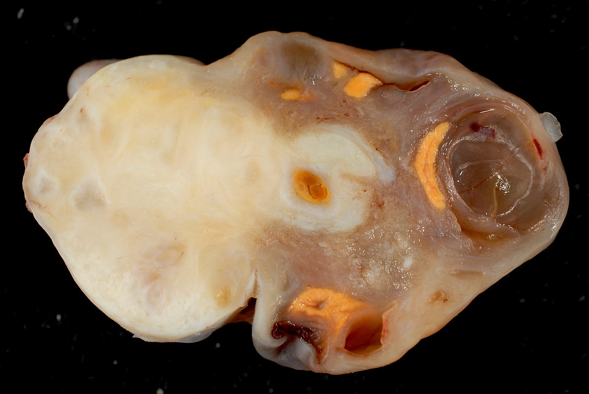File:1200px-Fibroma of the Ovary.jpg