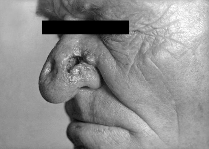 A photograph of a patient with tertiary syphilis resulting in gummas seen here on the nose. This patient presented with tertiary syphilitic gummas of the nose mimicking basal cell carcinoma. The gummatous tumors are benign and if properly treated, will heal and the patient will recover in most cases. Adapted from CDC