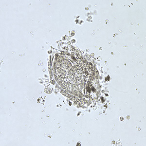 Egg of S. haematobium in a wet mount of a urine concentrate. Adapted from CDC