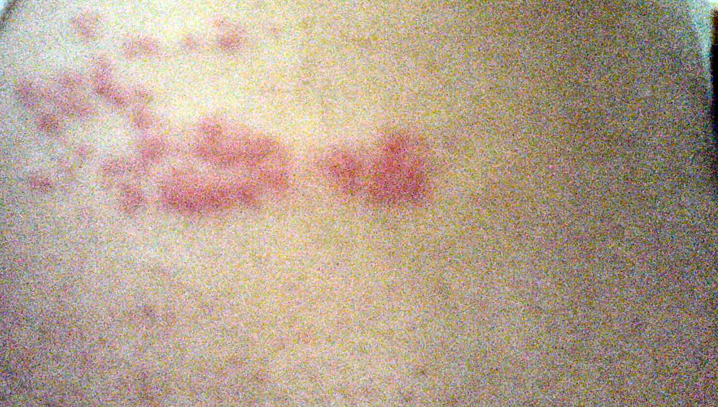 Herpes zoster blisters day 1.