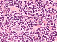 Micrograph showing a "popcorn cell", the Reed–Sternberg cell variant seen in nodular lymphocyte predominant Hodgkin lymphoma. H&E stain