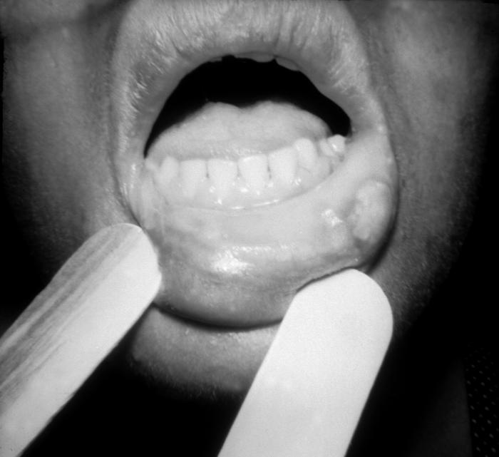 A photograph of mucous patches on the lower lips due to secondary syphilis. Mucous patches form during the breakdown of mucous membranes, seen here on the inside the lower lip. During the secondary stage of syphilis, mucous patches can also develop inside the mouth, vulva, and vagina. Adapted from CDC