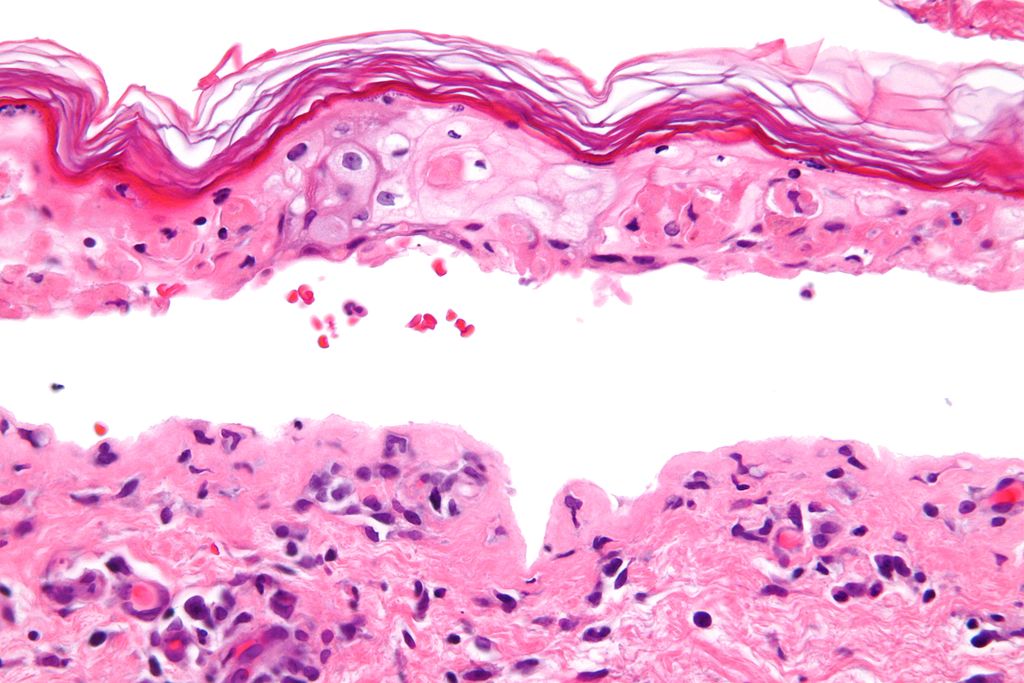 Histology of confluent epidermal necrosis (very high mag)Source:By Nephron - Own work, CC BY-SA 3.0, https://commons.wikimedia.org/w/index.php?curid=16874054[10]
