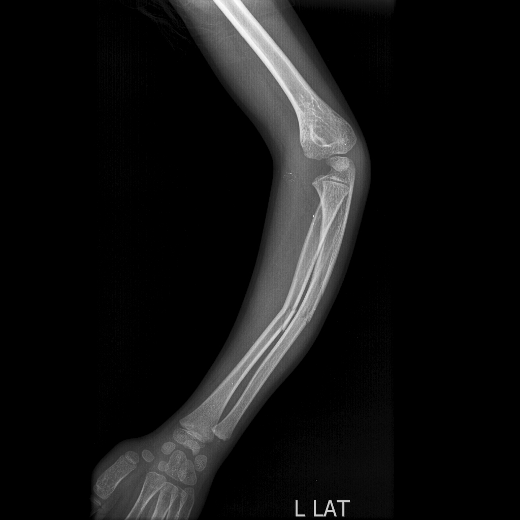 Radius and ulna greenstick fractures - Lateral view