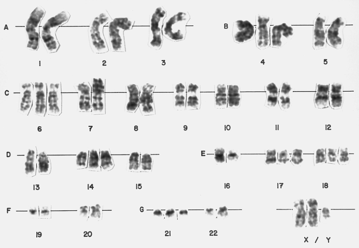 Hyperdiploid lymphoblast karyotype This bone marrow karyotype is from a 5-year-old female with ALL. There is hyperdiploidy with 55 chromosomes. Hyperdiploidy with greater than 50 chromosomes is found in approximately 25 percent of children with ALL and is associated with a good prognosis. (Giemsa-trypsin banding)