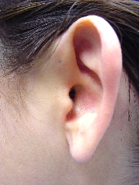Pre-auricular cyst.[2]