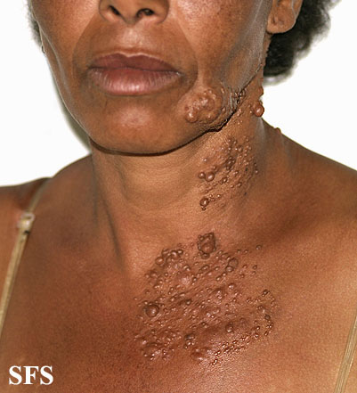 Segmental neurofibromatosis. With permission from Dermatology Atlas.[3]