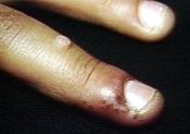 Nail Disease Onychoptosis