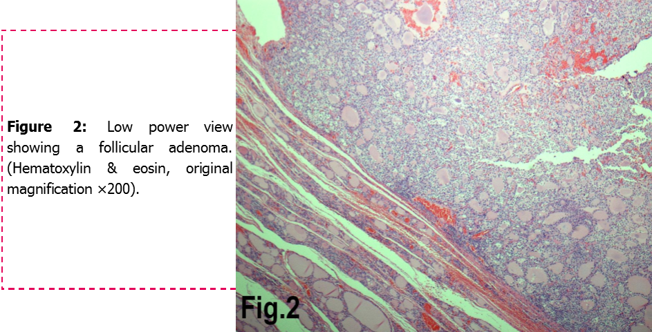 Follicular adenoma of the thyroid gland