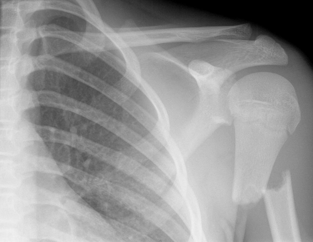 File:Proximal-humeral-fracture-in-child.jpg
