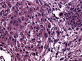 A smear showing rhabdoid meningiomao with abundant cytoplasm and cross-striations