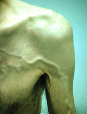 Distension of veins on the torso of a patient with SVC syndrome