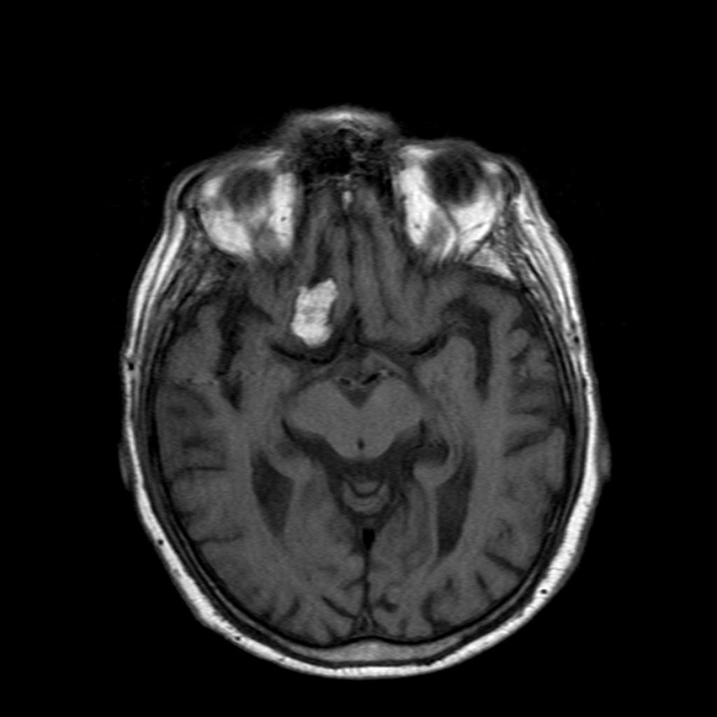 Intracranial dermoid cyst:A hyperintense well-delineated mass is seen in the right frontal lobe with it's base on the roof of the sphenoid sinus.[2]