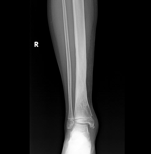 Sclerosis of the distal tibial diaphysis associated with bone expansion and soft tissue thickening.