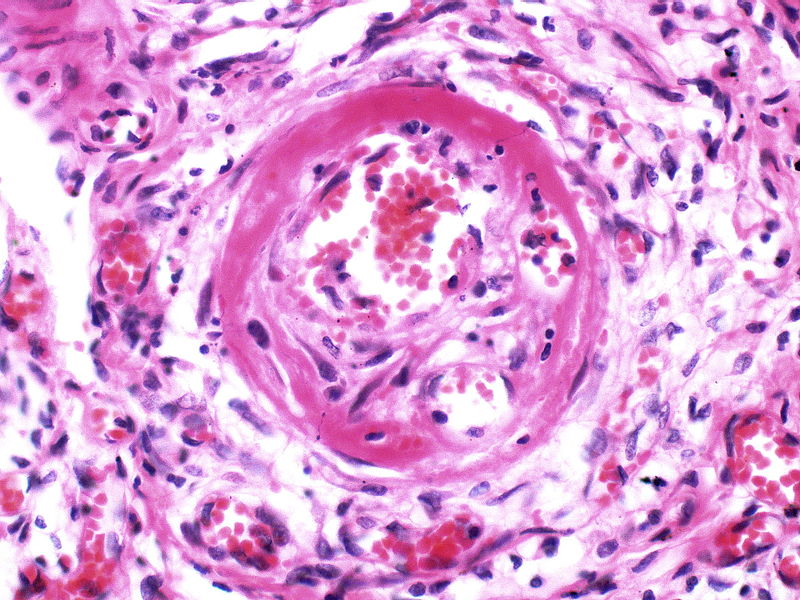 This arteriole exhibits fibrinoid necrosis