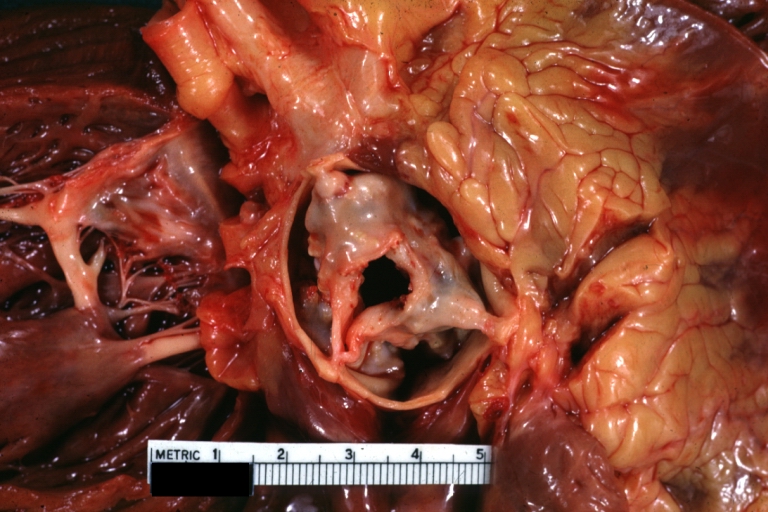 Aortic stenosis (Tricuspid aorta): gross, an example of aortic stenosis due to rheumatic fever