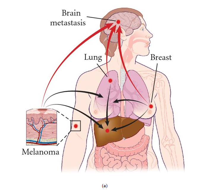 (a) Formation of metastatic tumor cell lines at primary sites like breast, lung, and skin (melanoma) seen as the red nodes. Metastasis from these primary sites then spreads to the brain via the circulatory system (red arrows) and also to adjacent sites like the liver, bone, lung, and lymph nodes (black arrows). The inset shows the primary site of melanoma cells proliferating and migrating towards the vasculature, subsequently disseminating to secondary organ sites.[1]