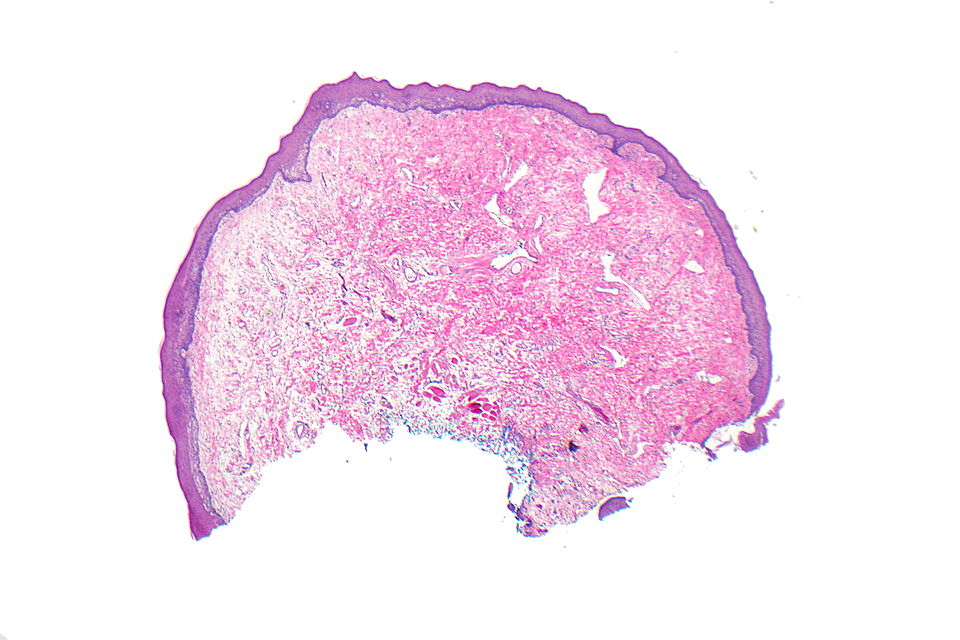 Histopathology specimen of a oral fibroma high magnification