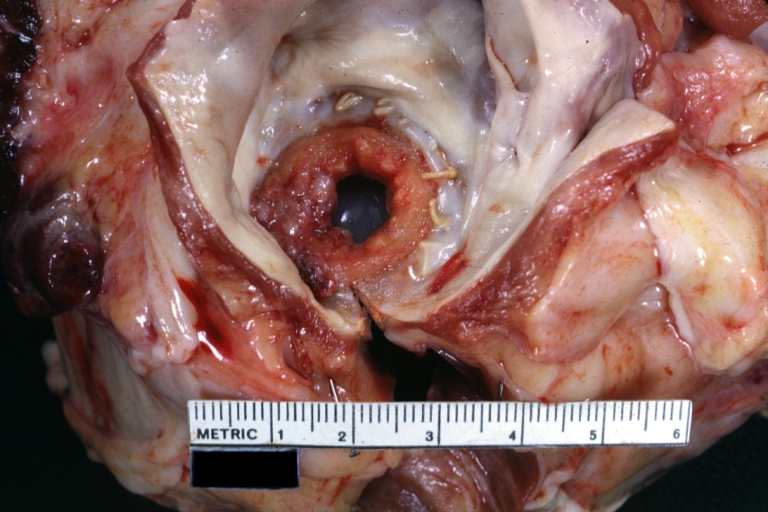 Mitral valve prosthesis with thrombosis: Gross, natural color, view from the left atrium, thrombus around rim of caged ball prosthesis.