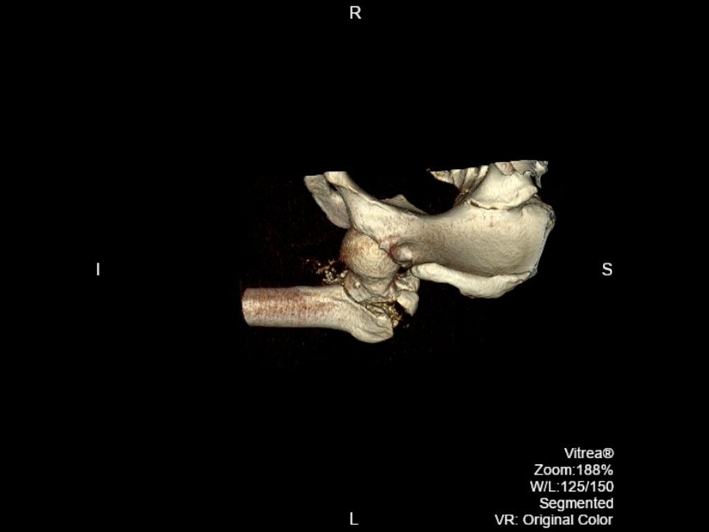 3D. Comminuted intertrochanteric fracture involving the left proximal femur with internal rotation the femur following a road traffic accident.