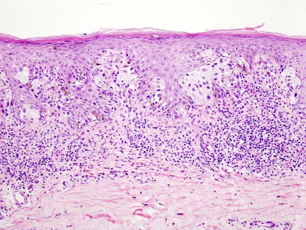 This case may represent superficial spreading melanoma.