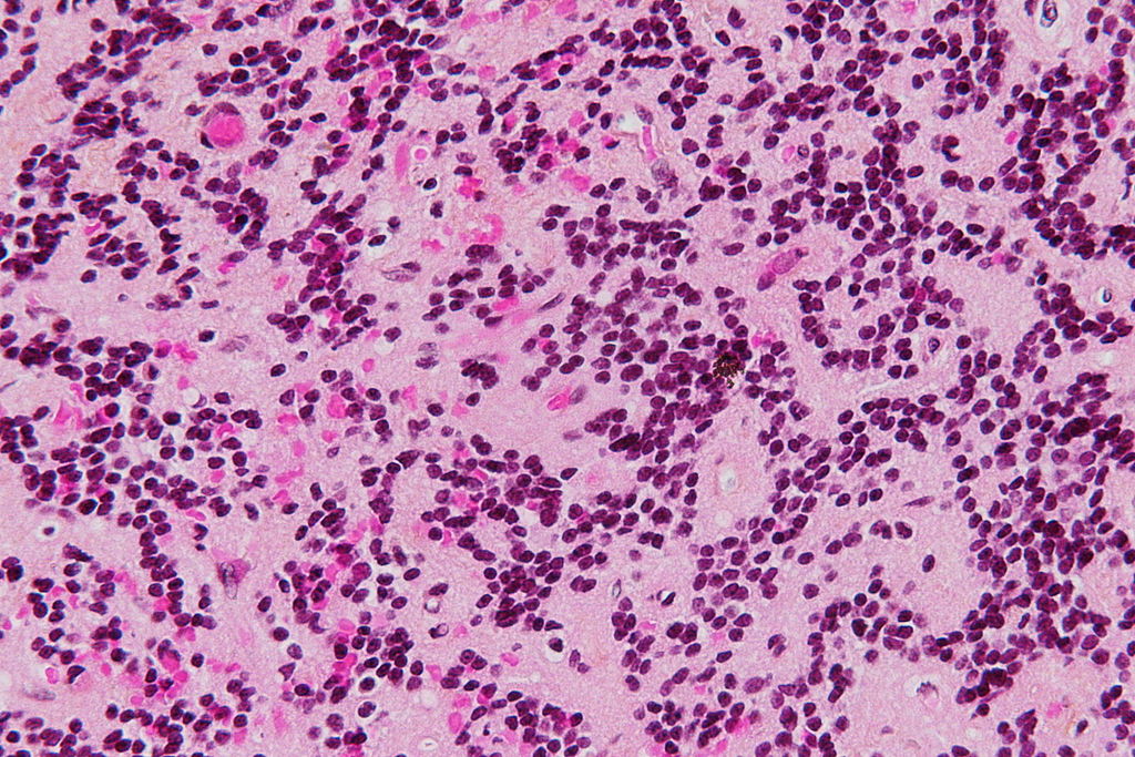 Very high magnification micrograph of a pineocytoma. HPS stain.[10]