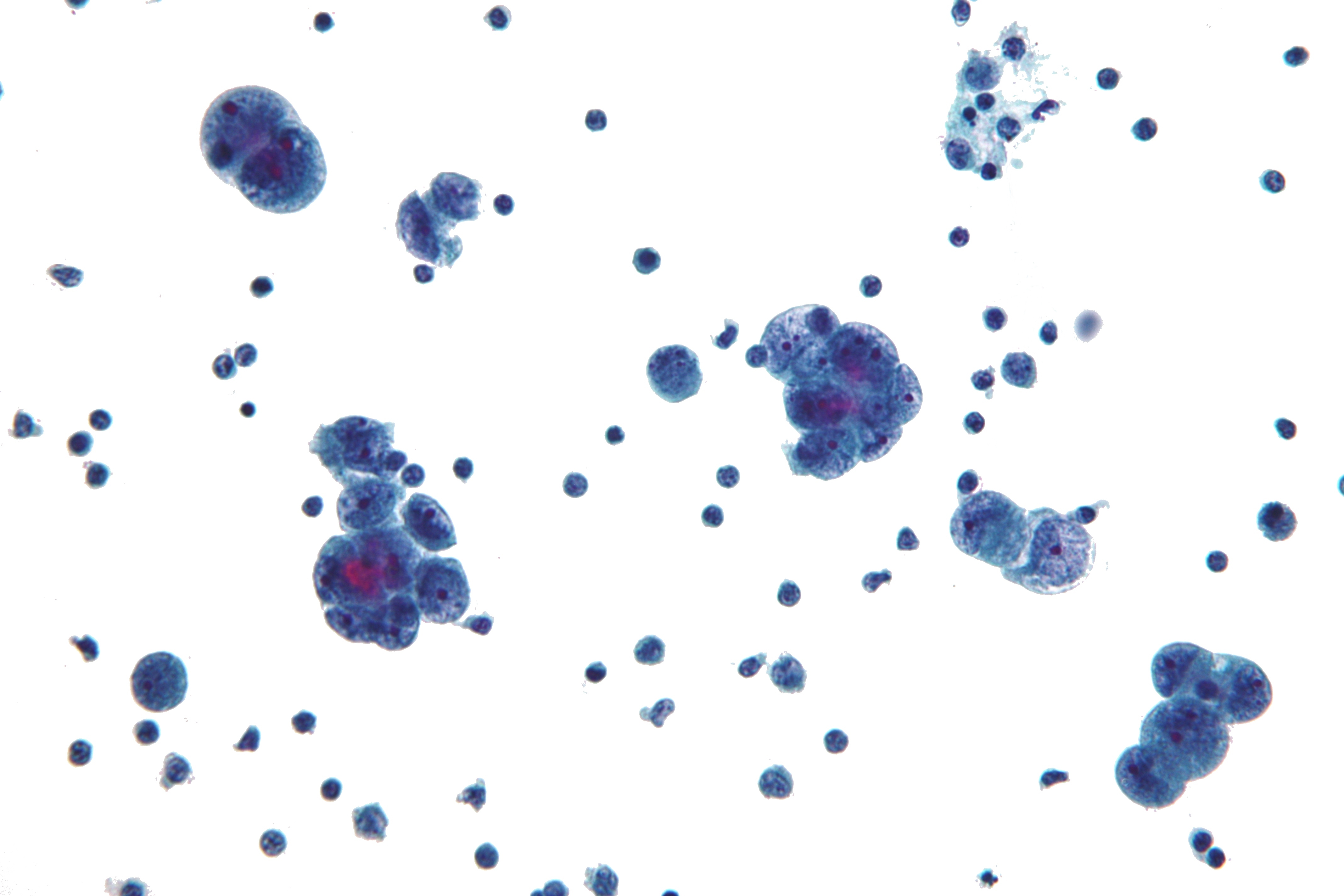 File:Serous carcinoma cytology.jpg
