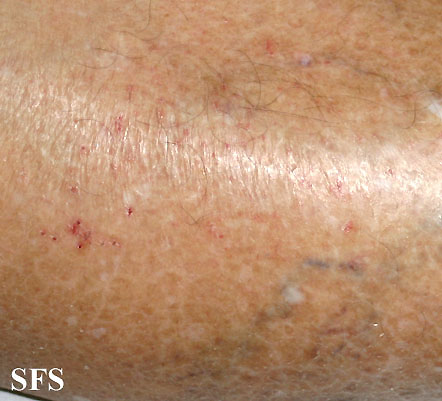 Xerotic eczema Adapted from Dermatology Atlas.<ref name="Dermatology Atlas">{{Cite