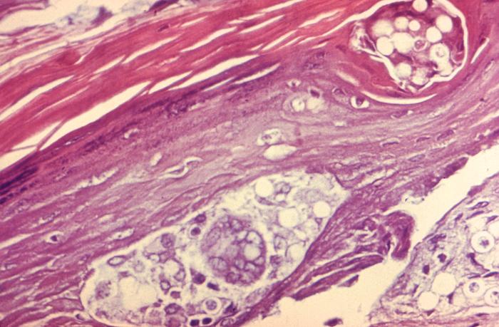 Ultrastructural histopathology in dermal skin tissue specimen in a patient with an intradermal keloidal blastomycosis infection. From Public Health Image Library (PHIL). [26]