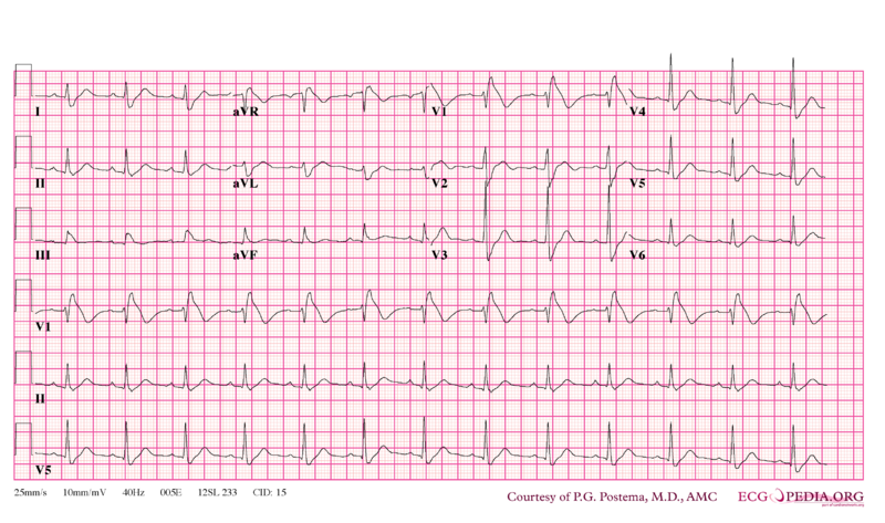 File:Brugada syndrome type1 example5.png