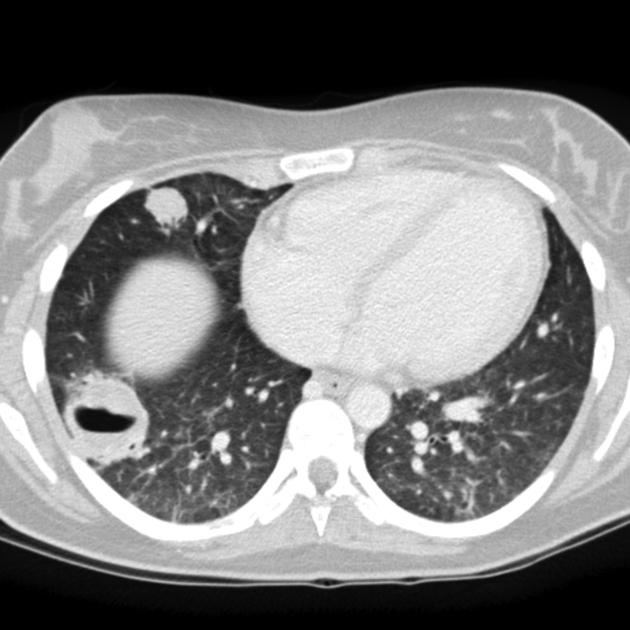 Granulomatosis with polyangiitis- CT scan showing nodules and cavities and ground glass opacification[2]