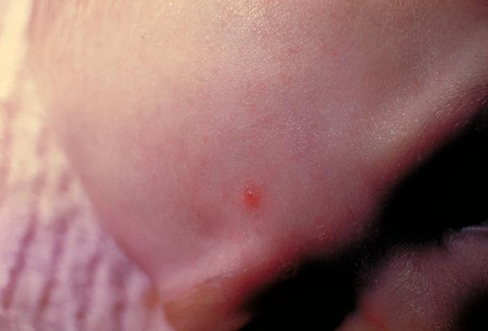 4-month old infant with skin lesions on his brow ridge due to chickenpox. From Public Health Image Library (PHIL). [1]