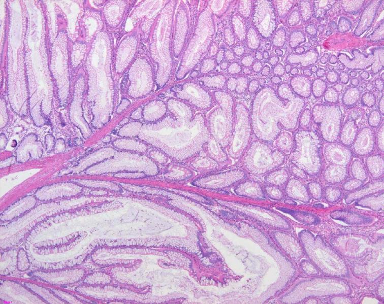 File:Colon histology with Peutz-Jeghers polyp.jpg