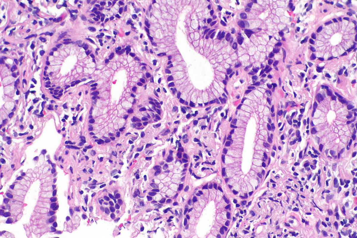 Micrograph showing an adenocarcinoma of the lung (acinar pattern). H&E stain. [13]