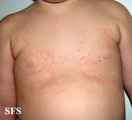 url = http://www.atlasdermatologico.com.br/disease.jsf?diseaseId=291>